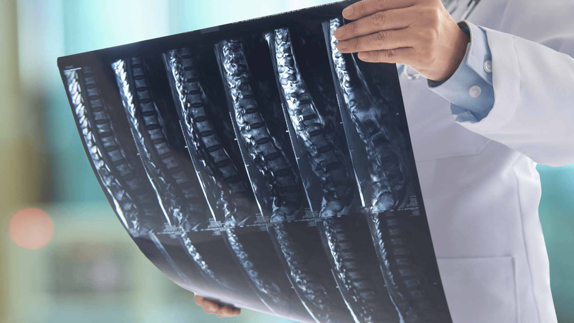 Trauma de columna (Fracturas y Lesiones)